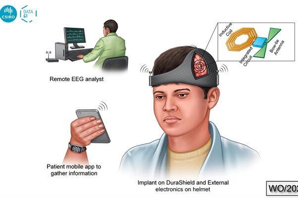 کلاه هوشمند از تشنج مغزی بعد از جراحی جلوگیری می&zwnjکند