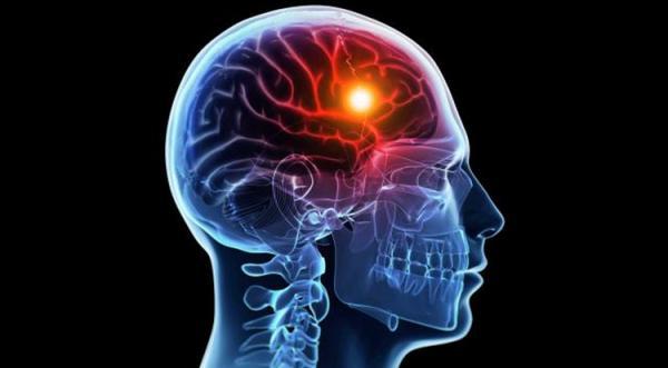 علائم مهم سکته کدام است؟ علائم مهم سکته کدام است؟